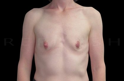 Breast Augmentation Before & After Patient #6541