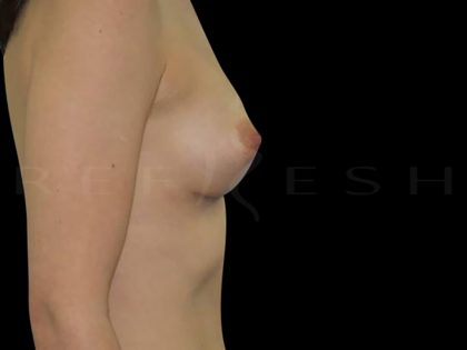 Breast Augmentation Before & After Patient #6540