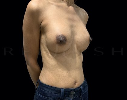 Breast Augmentation Before & After Patient #6538
