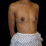 Breast Augmentation Before & After Patient #6538