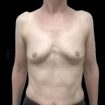 Breast Implant Removal Before & After Patient #6571
