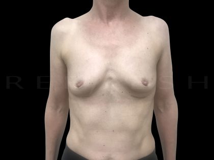 Breast Implant Removal Before & After Patient #6571