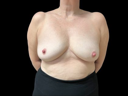 Breast Implant Removal Before & After Patient #6562