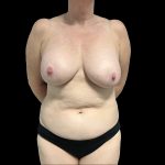 Breast Implant Removal Before & After Patient #6562