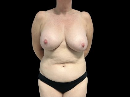 Breast Implant Removal Before & After Patient #6562