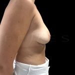 Breast Implant Removal Before & After Patient #6568