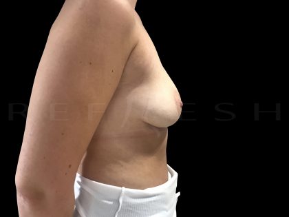 Breast Implant Removal Before & After Patient #6568