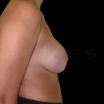 Breast Implant Removal Before & After Patient #6568