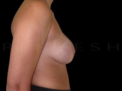 Breast Implant Removal Before & After Patient #6568