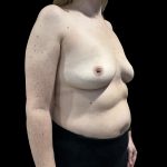 Breast Implant Removal Before & After Patient #6564