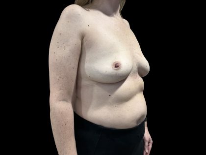 Breast Implant Removal Before & After Patient #6564