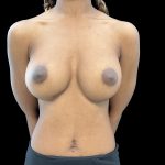 Breast Implant Removal Before & After Patient #6563