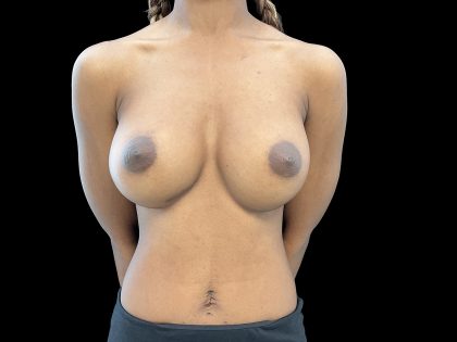 Breast Implant Removal Before & After Patient #6563