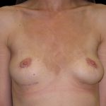 Breast Implant Removal + Breast Uplift Before & After Patient #6582