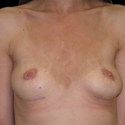 Breast Implant Removal with Breast Lift Before & After Patient #6582