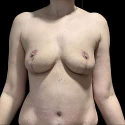 Breast Implant Removal with Breast Lift Before & After Patient #6573