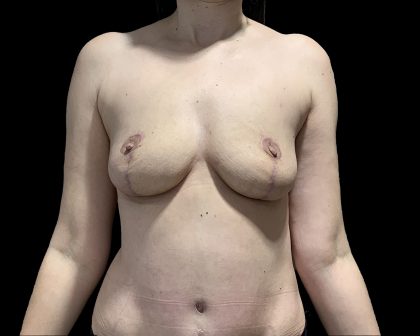 Breast Implant Removal + Breast Uplift Before & After Patient #6573