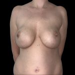 Breast Implant Removal + Breast Uplift Before & After Patient #6573