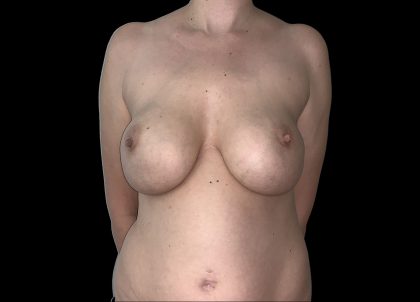 Breast Implant Removal + Breast Uplift Before & After Patient #6573