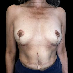 Breast Implant Removal with Breast Lift Before & After Patient #6572