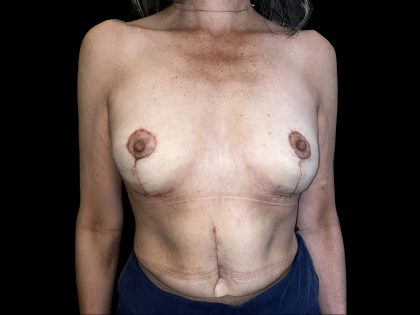 Breast Implant Removal + Breast Uplift Before & After Patient #6572