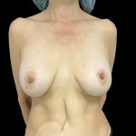 Breast Implant Removal + Breast Uplift Before & After Patient #6572