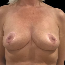 Breast Implant Removal with Breast Lift Before & After Patient #6581