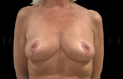 Breast Implant Removal + Breast Uplift Before & After Patient #6581