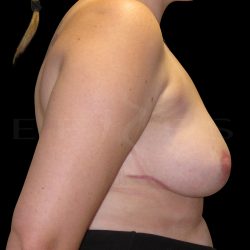 Breast Implant Removal with Breast Lift Before & After Patient #6580