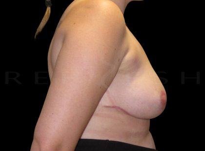 Breast Implant Removal + Breast Uplift Before & After Patient #6580