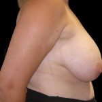 Breast Implant Removal + Breast Uplift Before & After Patient #6580