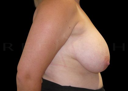 Breast Implant Removal + Breast Uplift Before & After Patient #6580