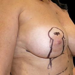 Breast Implant Removal with Breast Lift Before & After Patient #6577