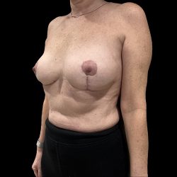 Breast Implant Removal with Breast Lift Before & After Patient #6575