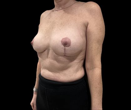 Breast Implant Removal + Breast Uplift Before & After Patient #6575