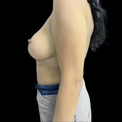 Breast Implant Removal with Breast Lift Before & After Patient #6574