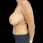 Breast Implant Removal + Breast Uplift Before & After Patient #6574