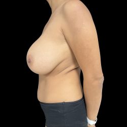 Breast Implant Removal with Breast Lift Before & After Patient #6574