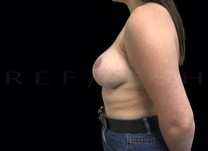 Breast Lift Before & After Patient #6594