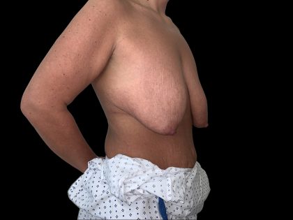 Breast Lift Before & After Patient #6585