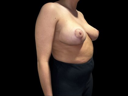 Breast Lift Before & After Patient #6583