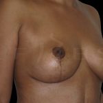 Breast Lift Before & After Patient #6593