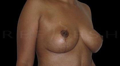 Breast Lift Before & After Patient #6593