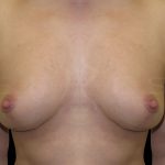 Breast Lift Before & After Patient #6589