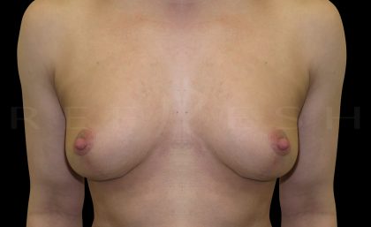 Breast Lift Before & After Patient #6589