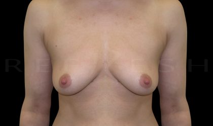 Breast Lift Before & After Patient #6589
