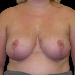 Vertical Lift + Implants Before & After Patient #6615