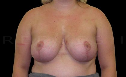 Vertical Lift + Implants Before & After Patient #6615
