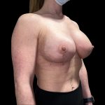 Vertical Lift + Implants Before & After Patient #6612