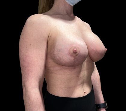 Vertical Lift + Implants Before & After Patient #6612